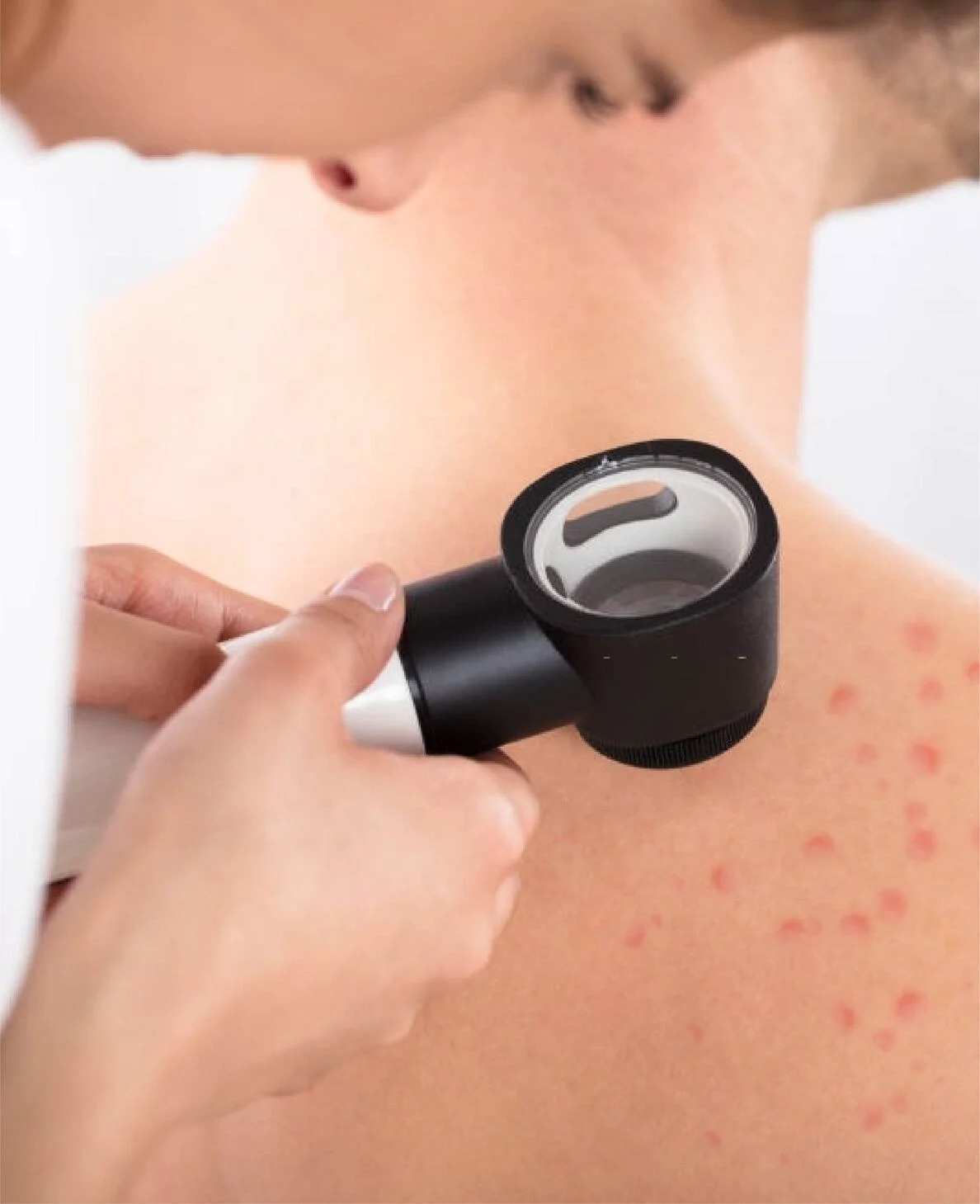 Dermatologist examining skin with a dermatoscope
